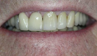 After - Smilemakerdentalcare