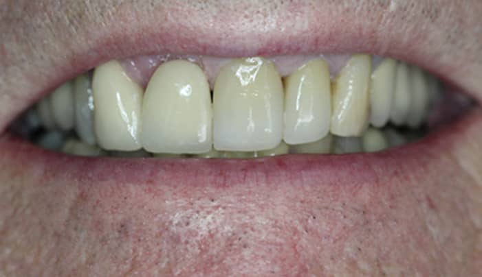 After - Smilemakerdentalcare