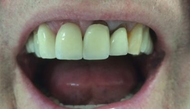 Before - Smilemakerdentalcare