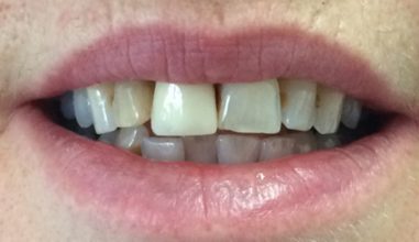 Before - Smilemakerdentalcare