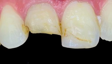 Before - Smilemakerdentalcare