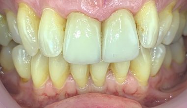 After - Smilemakerdentalcare