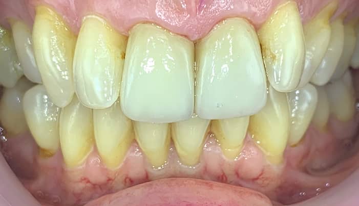 After - Smilemakerdentalcare