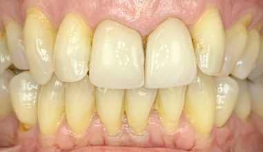 Before - Smilemakerdentalcare
