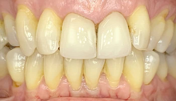 Before - Smilemakerdentalcare
