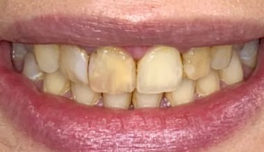 Before - Smilemakerdentalcare