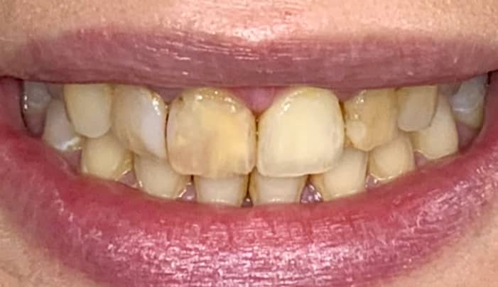 Before - Smilemakerdentalcare