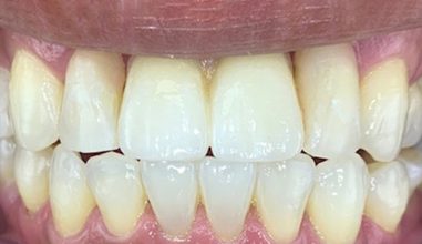 After - Smilemakerdentalcare