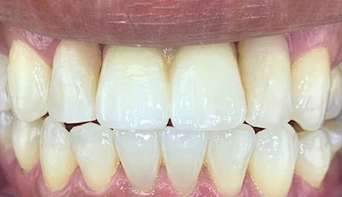 After - Smilemakerdentalcare