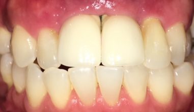 Before - Smilemakerdentalcare