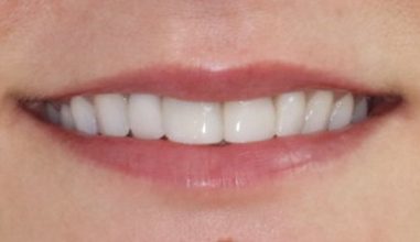 After - Smilemakerdentalcare