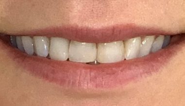 Before - Smilemakerdentalcare