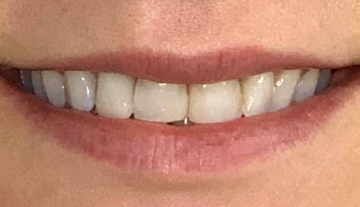 Before - Smilemakerdentalcare