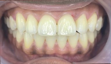 After - Smilemakerdentalcare