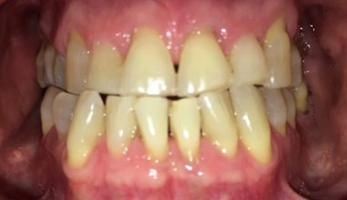 Before - Smilemakerdentalcare