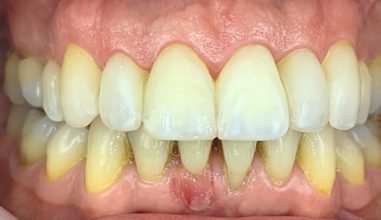 After - Smilemakerdentalcare