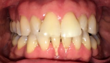 Before - Smilemakerdentalcare