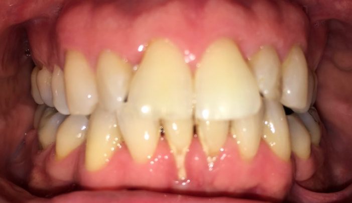 Before - Smilemakerdentalcare