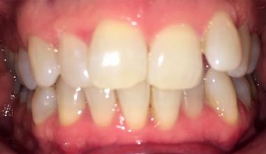 Before - Smilemakerdentalcare