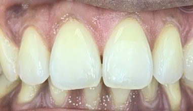 After - Smilemakerdentalcare