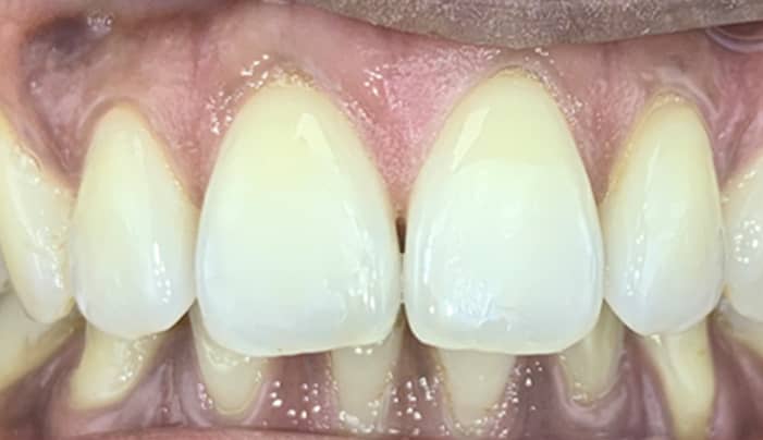 After - Smilemakerdentalcare