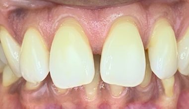Before - Smilemakerdentalcare