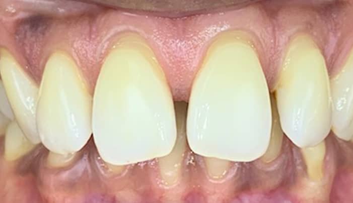 Before - Smilemakerdentalcare