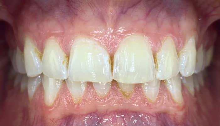 After - Smilemakerdentalcare