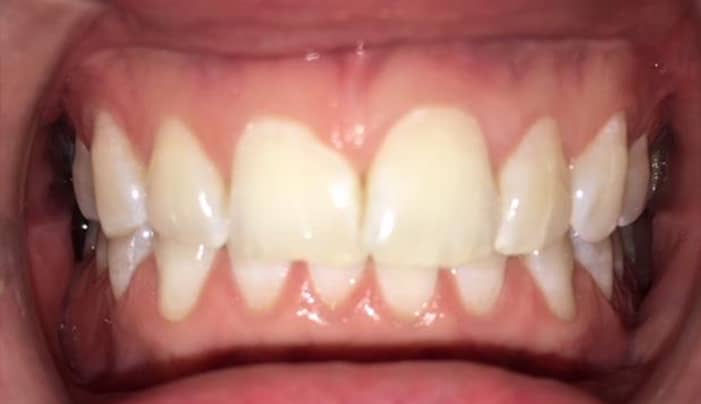 Before - Smilemakerdentalcare