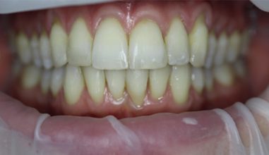 After - Smilemakerdentalcare