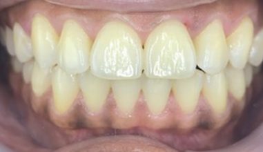 After - Smilemakerdentalcare