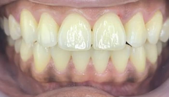 After - Smilemakerdentalcare