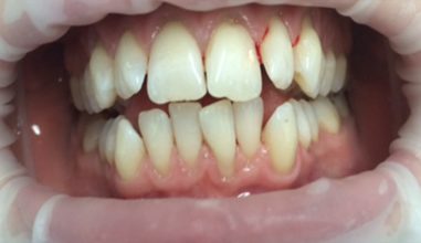 Before - Smilemakerdentalcare