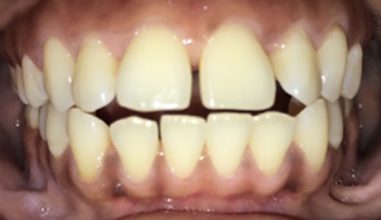 Before - Smilemakerdentalcare