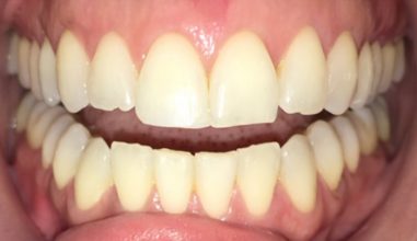 After - Smilemakerdentalcare