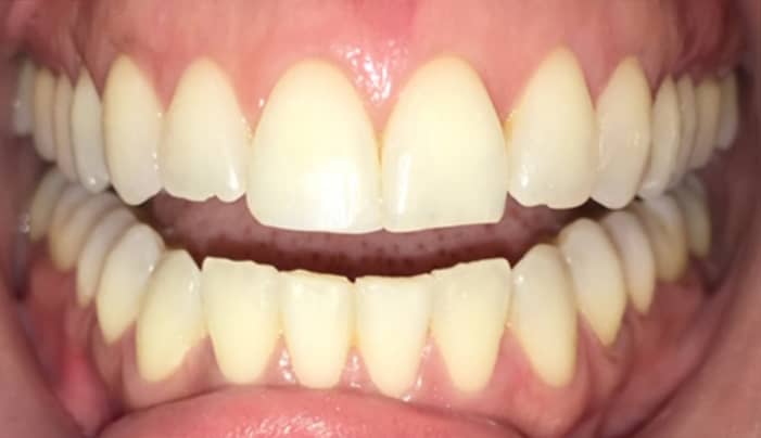 After - Smilemakerdentalcare