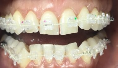 Before - Smilemakerdentalcare