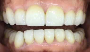 After - Smilemakerdentalcare