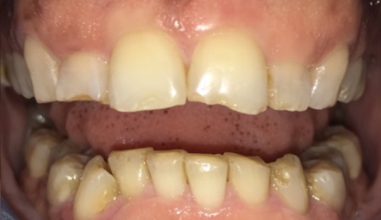 Before - Smilemakerdentalcare