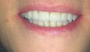 After - Smilemakerdentalcare
