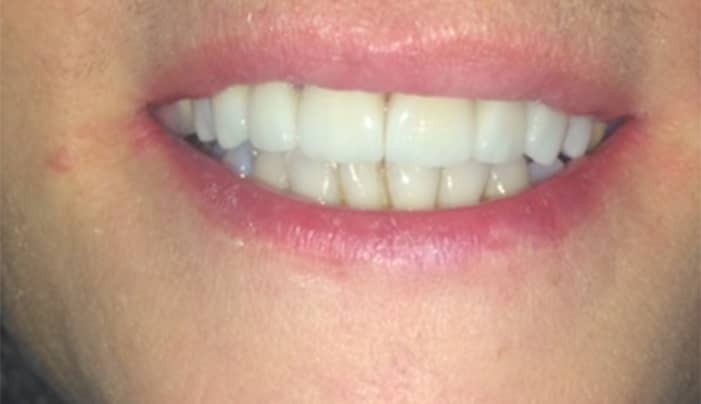 After - Smilemakerdentalcare