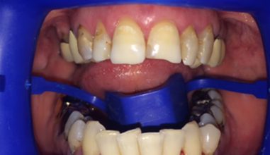 Before - Smilemakerdentalcare