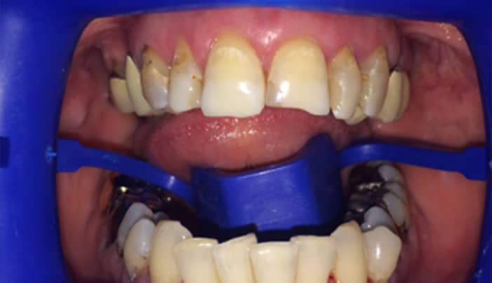 Before - Smilemakerdentalcare