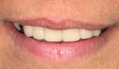 After - Smilemakerdentalcare
