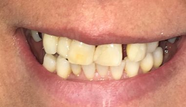 Before - Smilemakerdentalcare
