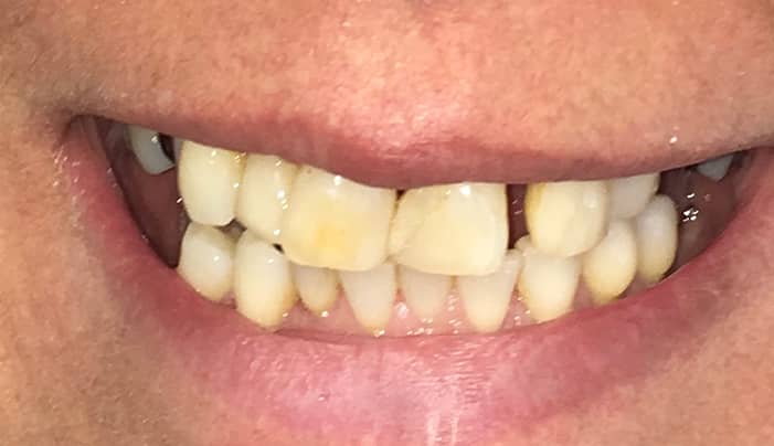 Before - Smilemakerdentalcare