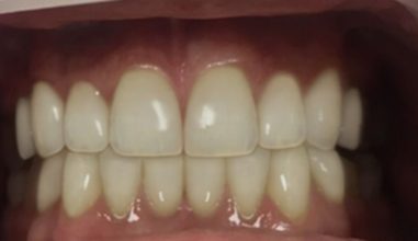 After - Smilemakerdentalcare
