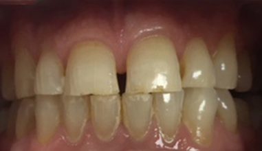 Before - Smilemakerdentalcare