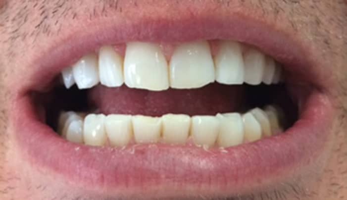 After - Smilemakerdentalcare