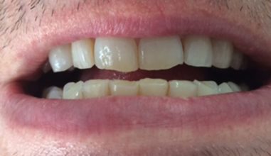 Before - Smilemakerdentalcare